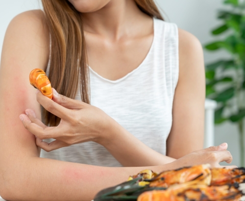 Vers un vaccin thérapeutique pour les allergies alimentaires